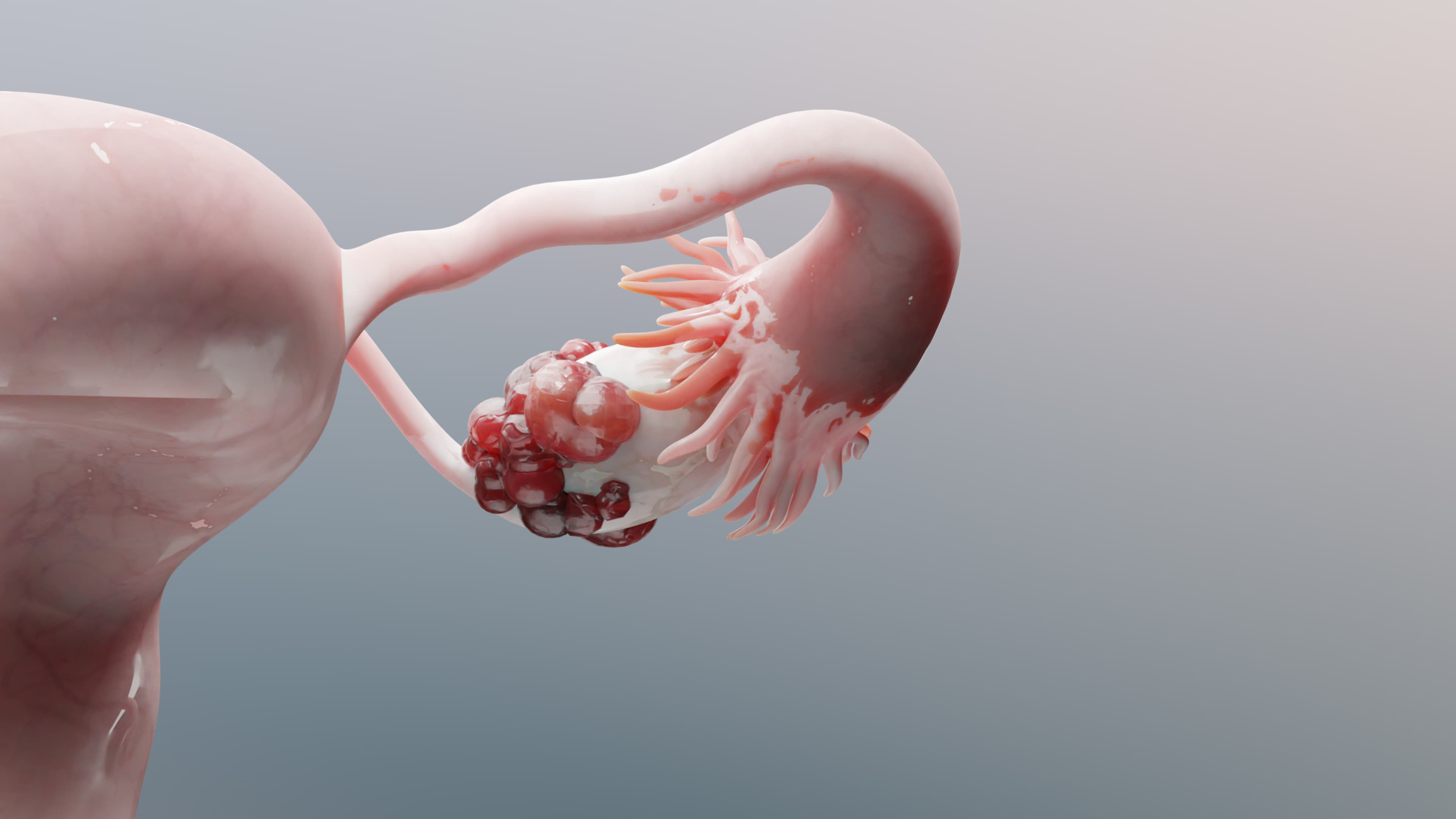 Ovarian Cancer - Health and Medicine